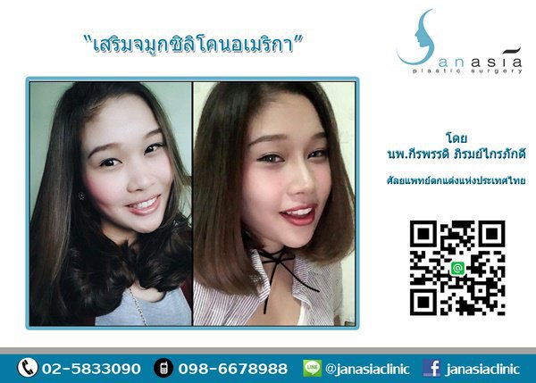 เสริมจมูกซิลิโคนอเมริกา (Before & After)