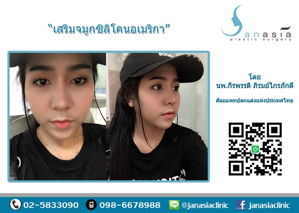 เสริมจมูกซิลิโคนอเมริกา